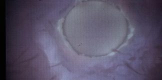 Infertilità maschile, trovati batteri in liquido seminale che ‘tagliano’ spermatozoi