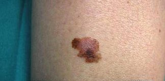 Tumori, contro melanoma il virus dell’herpes modificato funziona: lo studio