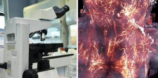 Covid invade il cervello, ecco il ‘film’. E la proteina Spike rimane per anni