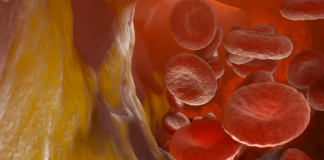 Studio italiano, terapia a Rna riduce colesterolo Ldl di oltre 60%