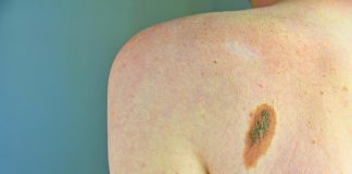 Tumori, +30% diagnosi melanoma in 2024, mai così tanti