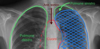 Tumore gli comprimeva cuore e polmone, salvato con complesso intervento alle Molinette