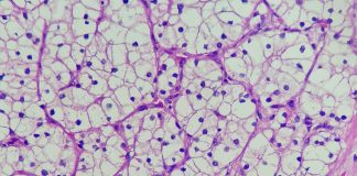 Studio, Tki e immunoterapia più efficace di sunitinib in carcinoma a cellule renali