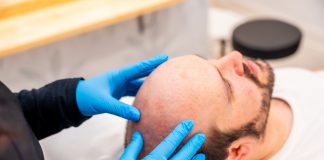 Tricopigmentazione: come funziona la tecnica di infoltimento non chirurgica