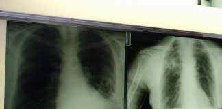 Cancro polmone a piccole cellule, ok Ue a tislelizumab