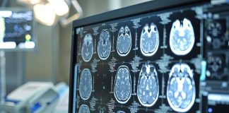 Telemedicina, progetto telestroke permette di trattare ictus a distanza