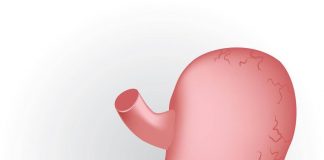 Caldo peggiora sintomi del reflusso, in casi gravi “chirurgia opzione risolutiva”
