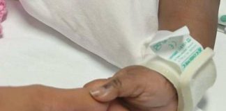 Gemelle siamesi separate al Gaslini di Genova: “Estubate, respirano da sole”