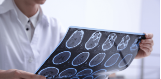 Sclerosi multipla e maternità, neurologa Marfia: “Personalizzare percorso”