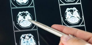 Intelligenza Artificiale può prevedere evoluzione Parkinson, lo studio italiano
