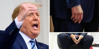 Trump e le gambe gonfie, cos’è l’insufficienza venosa cronica