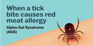Se una zecca rende allergici a carne e latticini, cos’è la sindrome alfa-gal