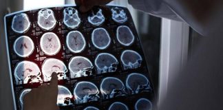 Rallentare l’Alzheimer con il litio, scoperta la ‘scintilla’ che innesca la patologia?
