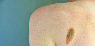 Prevenzione melanoma, Sidemast pronta a collaborare per percorsi chiari
