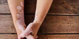Estate, vitiligine e sole: le regole per una abbronzatura sicura