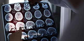 Nuove molecole e bersagli, così si evolve la terapia contro l’Alzheimer: il punto
