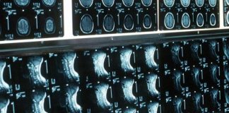 Ipofosfatemia legata all’X, primo bilancio e prospettive su linee guida