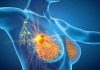 Cancro seno iniziale Her2+, con anticorpo farmaco-coniugato -53% recidiva