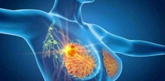 Cancro seno iniziale Her2+, con anticorpo farmaco-coniugato -53% recidiva