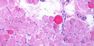 Malattie rare, risultati positivi a 5 anni per vamorolone in distrofia Duchenne