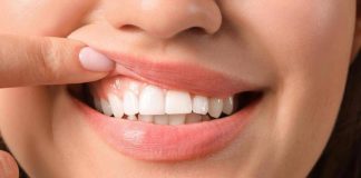 Diabete, parodontologi ‘malattie gengivali complicano il tipo 2’