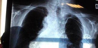 Polmonite, ogni anno in Italia 150mila ricoveri e 9mila morti: i sintomi