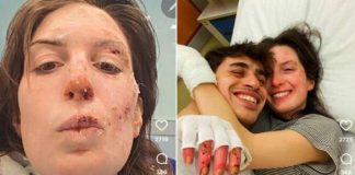 Crans-Montana, oggi dimessi due ragazzi. Eleonora Palmieri mostra le ustioni sui social