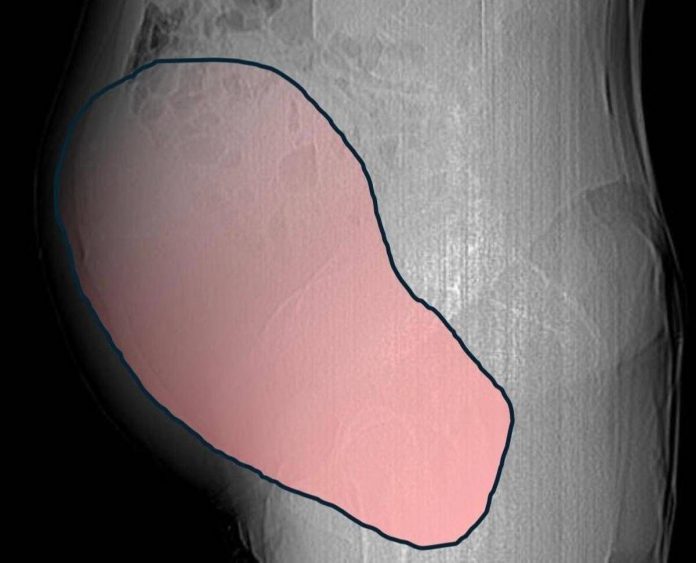 tumore_ovarico_6kg_us