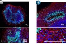 Studio italiano, ‘la Sma colpisce dall’embrione, cruciali screening e cure precoci’