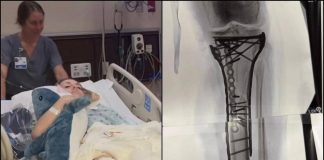 Milano Cortina, Vonn mostra la gamba dopo le operazioni: “Dolore difficile da gestire”
