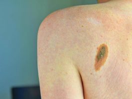 Melanoma, Ascierto (Scito): “Con immunoterapia più speranze per metà forme gravi”