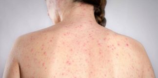 Morbillo, dagli aeroporti Usa alle scuole di Londra: dilagano gli alert