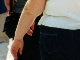 Una morte per malattie infettive su 10 è legata all’obesità, lo studio