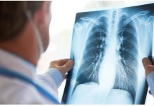 Tumore al polmone a piccole cellule in stadio esteso, ok Aifa a primo anti Pd-1 in prima linea