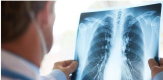 Tumore al polmone a piccole cellule in stadio esteso, ok Aifa a primo anti Pd-1 in prima linea