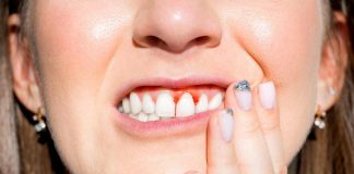 In Italia 9 mln con parodontiti, ‘più cure soft e veloci per fermare boom casi’