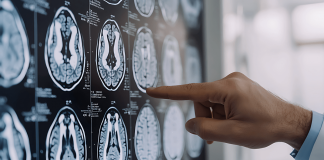 Tumori: glioma, Fda riconosce come farmaco orfano l’isotopo rame-64 sviluppato nelle Marche
