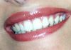 Dentista senza prenotazione a Roma, all’Isola Tiberina visite immediate per urgenze e controlli