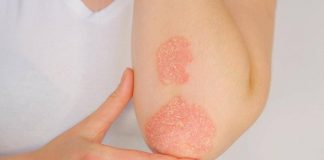 Psoriasi, dati positivi per inibitore orale di Tyk2 di nuova generazione