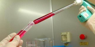 Melanoma uveale metastatico: “Tebentafusp raddoppia sopravvivenza a 5 anni”