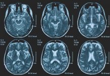Tumori, glioma pediatrico di basso grado: via libera in Europa a prima terapia mirata