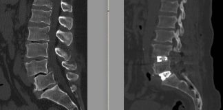 Chirurgia vertebrale complessa, al Tiberia Hospital di Roma intervento con tecnica Alif