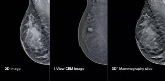 Mammografia ‘intelligente’ al San Camillo di Roma, aiuterà gli specialisti nelle diagnosi