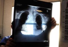 Sirm: “Ai strumento anti liste d’attesa, 50% esami imaging per over70 non necessario”