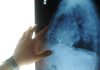 Radiologia interventistica, Ssn e fondazioni per cure più accessibili