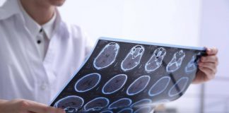 Sin: “Diagnosi più rapide e farmaci innovativi cambiano decorso sclerosi multipla”