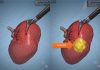 Modelli tridimensionali biomimetici del cancro al rene di un paziente per chirurgia robotica sempre più precisa