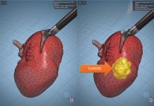 Modelli tridimensionali biomimetici del cancro al rene di un paziente per chirurgia robotica sempre più precisa