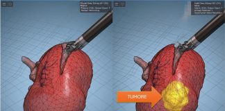 Modelli tridimensionali biomimetici del cancro al rene di un paziente per chirurgia robotica sempre più precisa