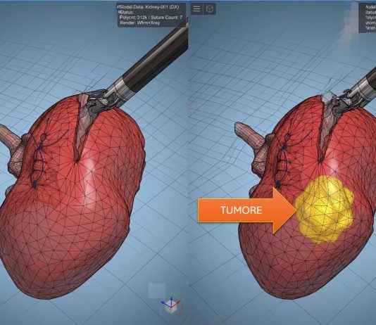 Modelli tridimensionali biomimetici del cancro al rene di un paziente per chirurgia robotica sempre più precisa